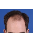 Before Hair Transplant&nbsp;Front